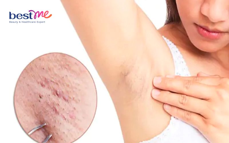 u-ba-dau-o-nach-hinh-anh-nguyen-nhan-va-cach-tri-hieu-qua-1 U bã đậu ở nách: Hình ảnh, nguyên nhân và cách trị hiệu quả - 1