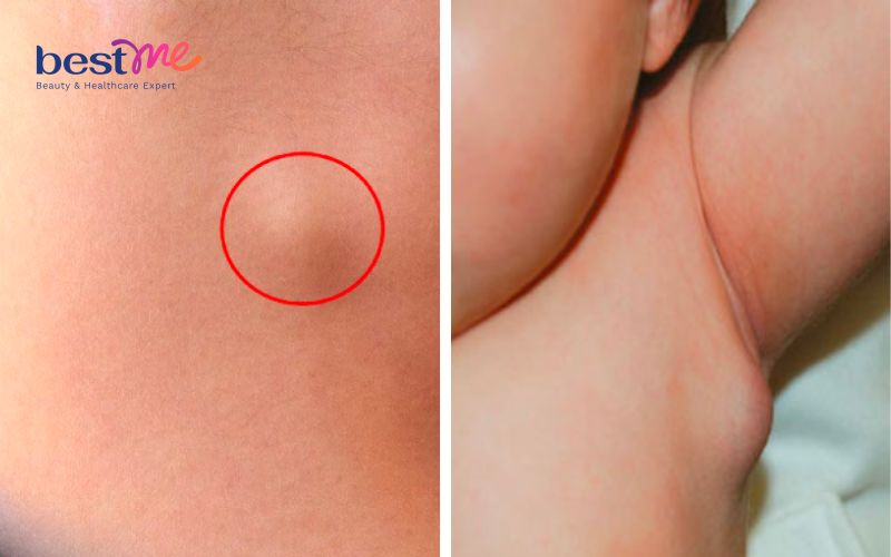 u-ba-dau-o-nach-hinh-anh-nguyen-nhan-va-cach-tri-hieu-qua-3 U bã đậu ở nách: Hình ảnh, nguyên nhân và cách trị hiệu quả - 3