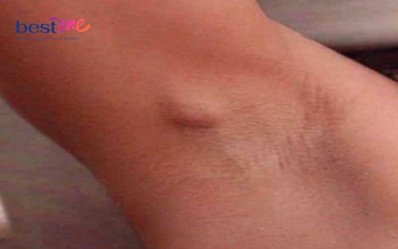 u-ba-dau-o-nach-hinh-anh-nguyen-nhan-va-cach-tri-hieu-qua-5 U bã đậu ở nách: Hình ảnh, nguyên nhân và cách trị hiệu quả - 5