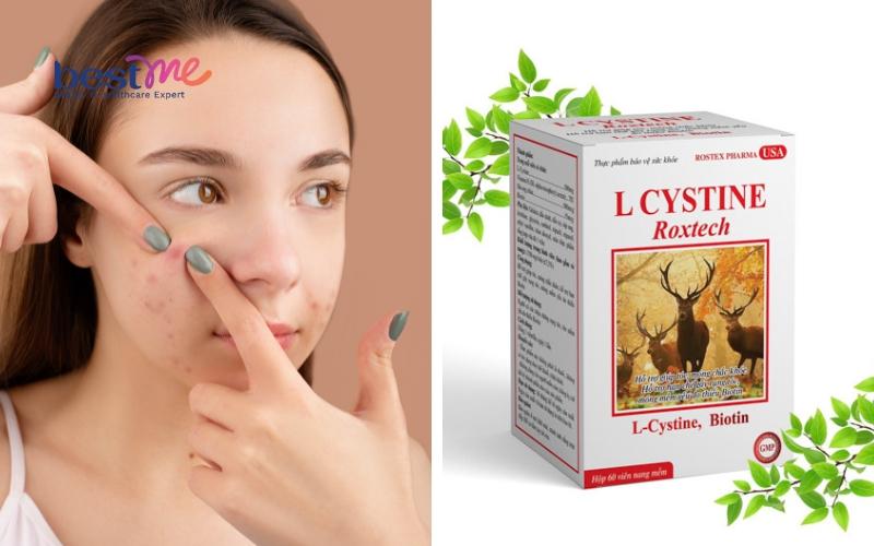 uong-l-cystine-bi-noi-mun-trong-bao-lau-nen-lam-gi-de-het-mun-2 Uống L cystine bị nổi mụn trong bao lâu? Nên làm gì để hết mụn? - 2