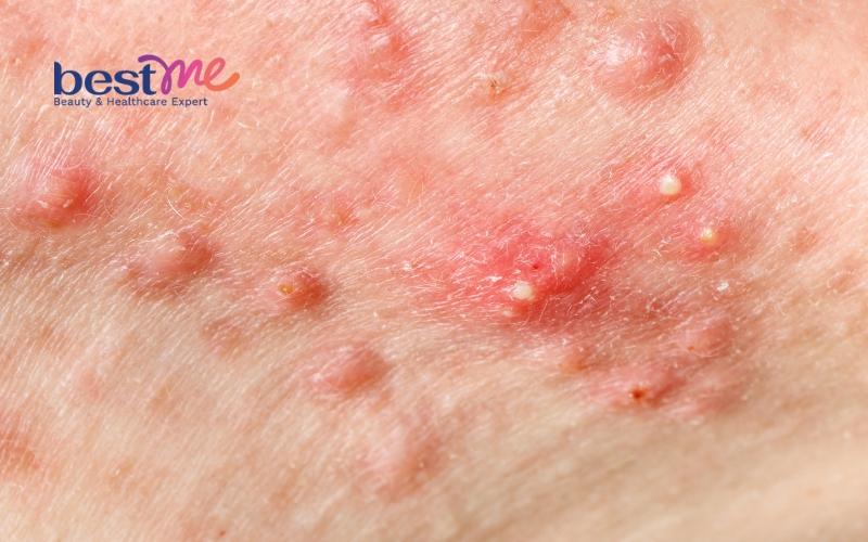 uong-l-cystine-bi-noi-mun-trong-bao-lau-nen-lam-gi-de-het-mun-3 Uống L cystine bị nổi mụn trong bao lâu? Nên làm gì để hết mụn? - 3