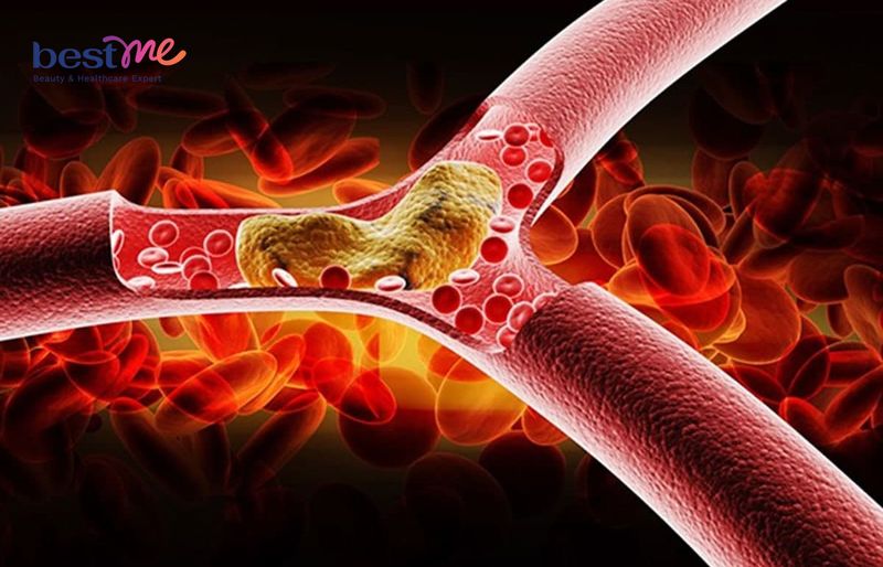 Mỡ máu tồn tại trong cơ thể