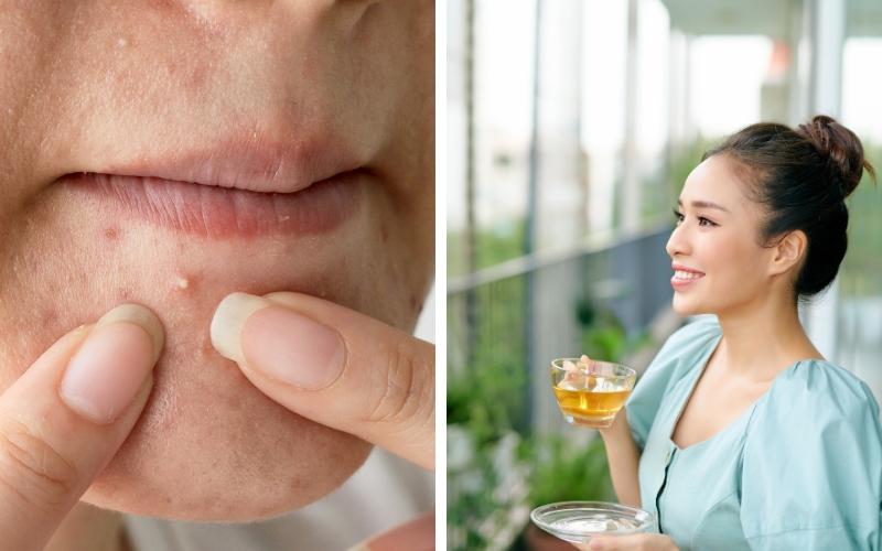 uong-tra-co-noi-mun-khong-nen-uong-tra-gi-khong-lo-mun-1 Uống trà có nổi mụn không? Nên uống trà gì không lo mụn? - 1