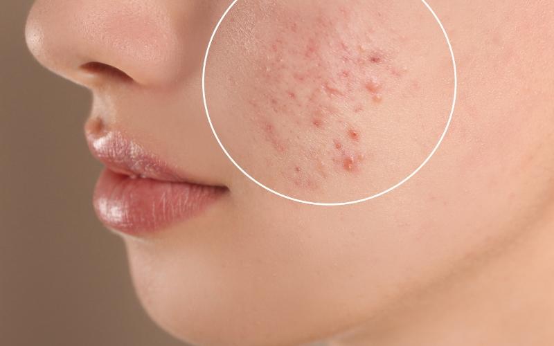 uong-tra-co-noi-mun-khong-nen-uong-tra-gi-khong-lo-mun-2 Uống trà có nổi mụn không? Nên uống trà gì không lo mụn? - 2