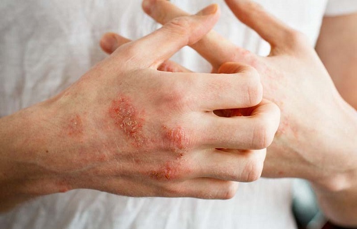 Bạn cần hạn chế gãi ngứa khi bị viêm da kích ứng