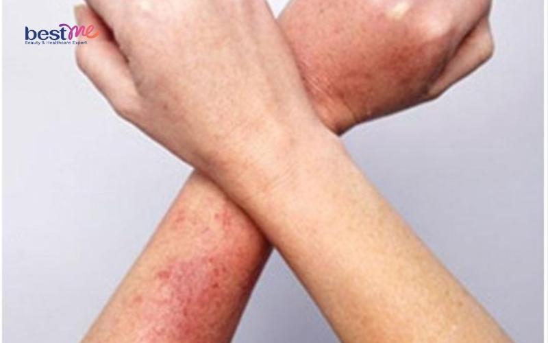 viem-lo-chan-long-o-tay-nguyen-nhan-va-cach-tri-triet-de-3 Viêm lỗ chân lông ở tay? Nguyên nhân và cách trị triệt để - 3
