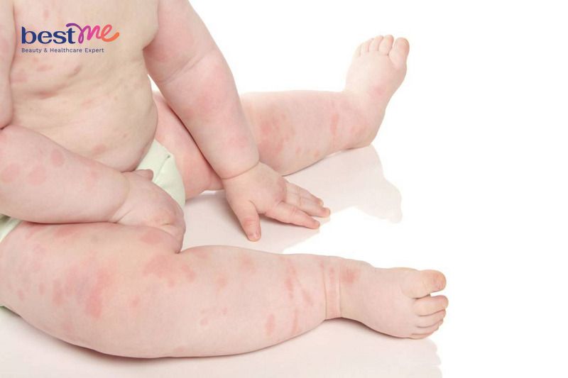 Trẻ có thể bị nổi mề đay nếu bổ sung vitamin D3 quá liều