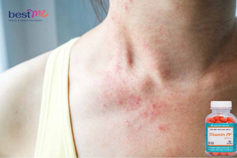 vitamin-pp-500mg-co-cong-dung-gi-co-nen-tu-y-bo-sung-hay-khong-2 Vitamin PP 500mg có công dụng gì? Có nên tự ý bổ sung hay không? - 2