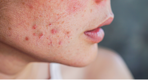 Cách chăm sóc da sau nặn mụn để không bị sẹo thâm