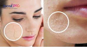 Da mặt bị bong tróc vảy trắng: 10 nguyên nhân và cách khắc phục