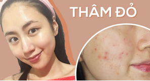 Da sau mụn bị thâm đỏ phải làm sao?