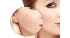 Điểm danh các cách chăm sóc da đẹp đánh bay mụn ngay tại nhà