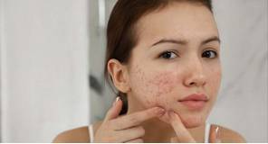 Mụn dị ứng mỹ phẩm là gì? Cách nhận biết và xử lý hiệu quả