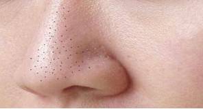 Hiểu rõ nguyên nhân và cách trị mụn đầu đen hiệu quả nhất