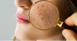 Bỏ túi 8 bước skincare phục hồi da sau mụn
