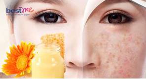Sữa ong chúa có tác dụng gì cho da mặt? Cách sử dụng tốt nhất