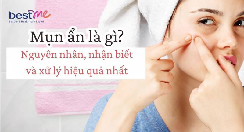 Mụn ẩn là gì? Nguyên nhân bị và cách xử lý nhanh hết nhất