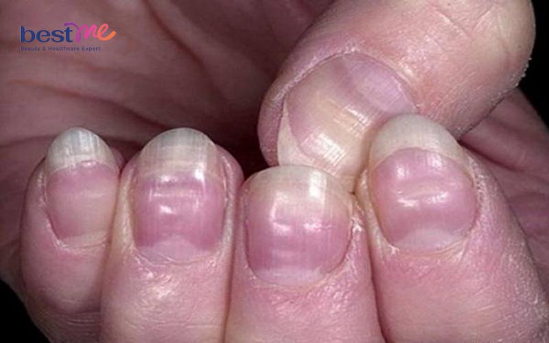 xem-dau-hieu-tren-mong-tay-bieu-hien-suc-khoe-cua-ban-5 Xem dấu hiệu trên móng tay biểu hiện sức khỏe của bạn - 5