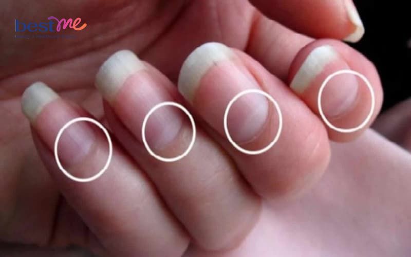 xem-dau-hieu-tren-mong-tay-bieu-hien-suc-khoe-cua-ban-6 Xem dấu hiệu trên móng tay biểu hiện sức khỏe của bạn - 6
