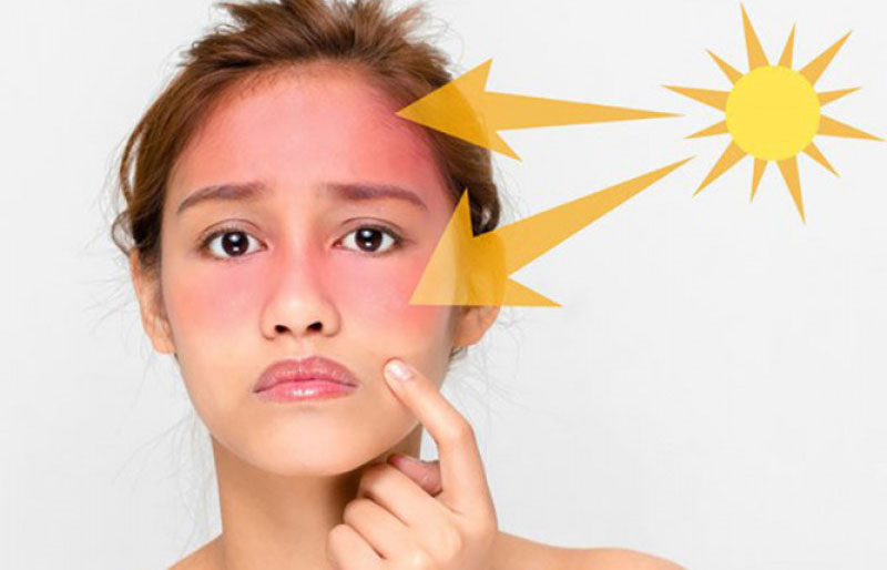Kiểm tra tình trạng cháy nắng của làn da
